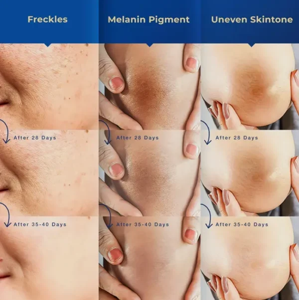 Spot Body: Melasma