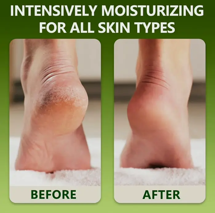 Tea Tree Heel Moisturizer - Repair Cracked Heels - 6.35 oz.