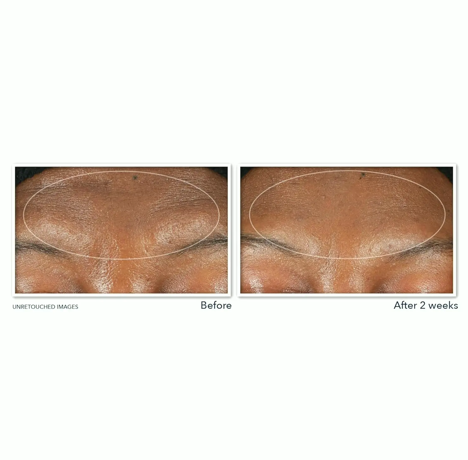 RoC's Retinol Anti-Wrinkle Cleanser, 6 Container