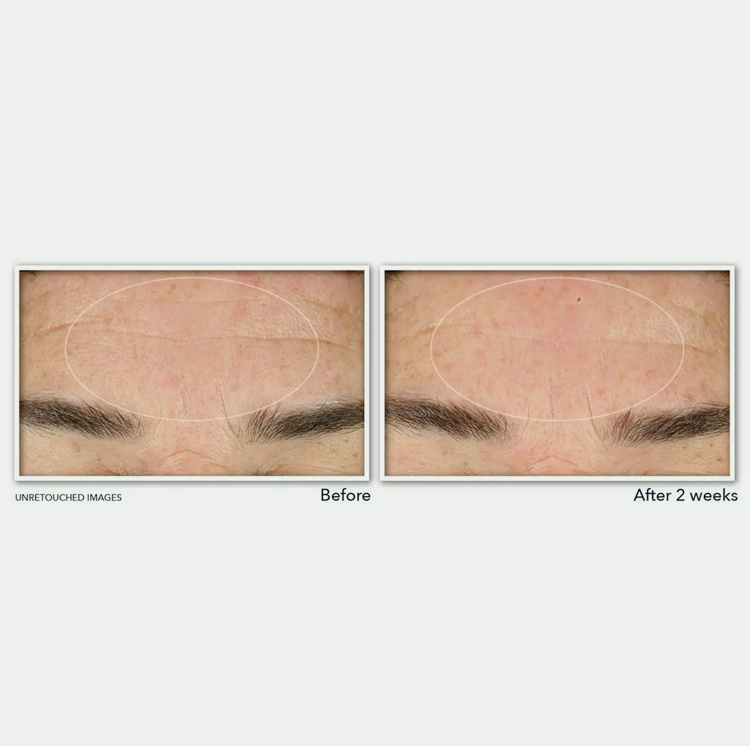 RoC's Retinol Anti-Wrinkle Cleanser, 6 Container
